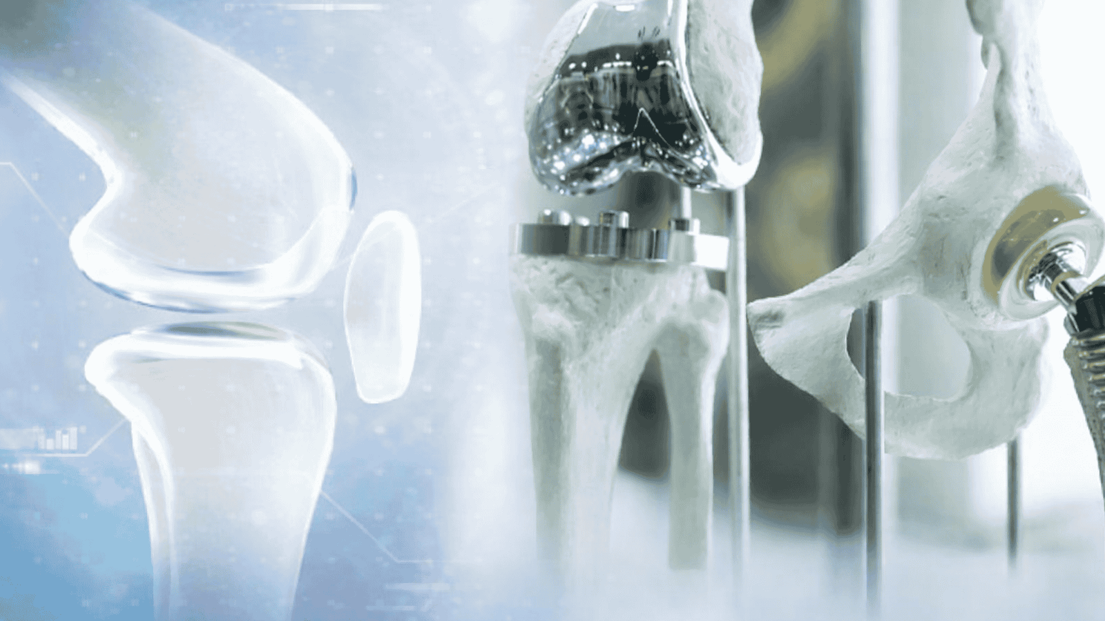 Locking Plate System (Orthopedic Locked Plates)